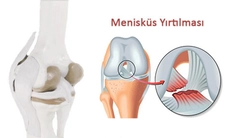 İç Menisküs Belirtileri ve Tedavisi