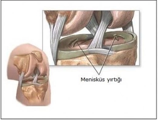 2 Derece Menisküs Yırtığı Belirtileri ve Tedavisi