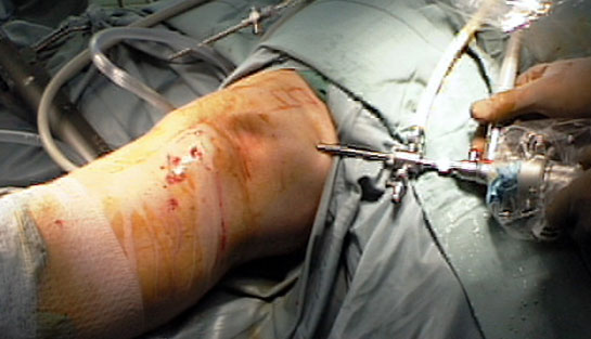 Artroskopi Nedir? ve Nasıl Yapılır