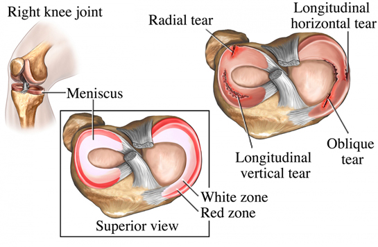 Menisks Nedenleri